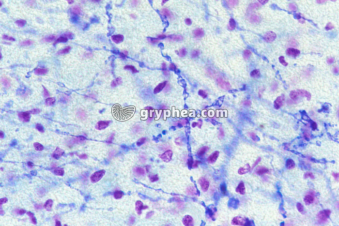 Sclérose en plaques - cerveau présentant des fibres nerveuses démyélinisées x160 - gryphea.com